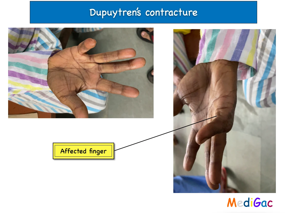 Dupuytren's contracture